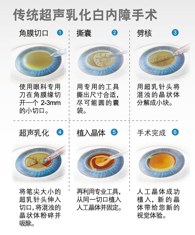 飛秒白內(nèi)障和傳統(tǒng)白內(nèi)障手術(shù)的區(qū)別